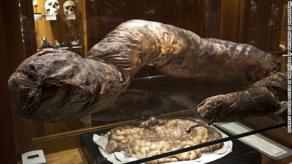 Đoạn ruột nặng 22 kg - một trong những mẫu vật độc đáo nhất trong bảo tàng