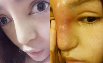 Chiếc mũi đáng sợ của cô gái là di chứng sau phẫu thuật thẩm mỹ thất bại