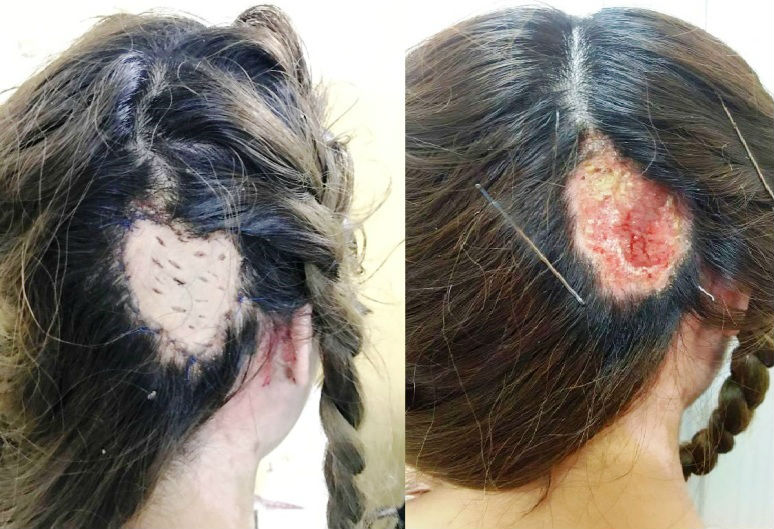 Phần da đầu bị bỏng của thiếu nữ 16 tuổi khi đi uốn tóc