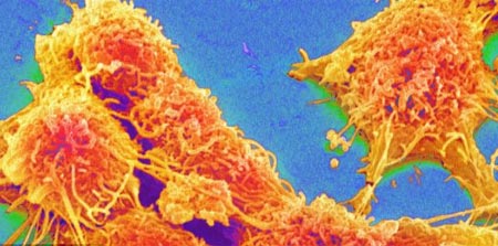 Hình ảnh các tế bào ung thư ruột