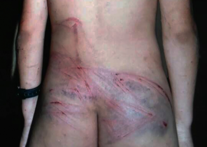 Những vết đánh thâm tím in rõ trên da và rỉ máu, nhất là ở mông, lưng, bụng và cả bộ phận sinh dục của trẻ bị bạo hành dã man