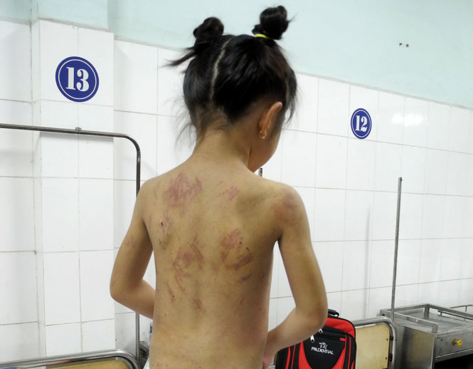 Các vết bầm tím chi chít trên trẻ bị bạo hành dã man ở Tây Ninh