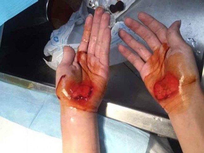 Hình ảnh bàn tay học sinh chảy máu sau khi bị phạt đang khiến dư luận Trung Quốc phẫn nộ