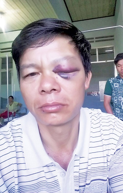 Mắt trái của kiểm lâm Phạm Minh Tiến sưng húp, bầm đen vì bị hành hung