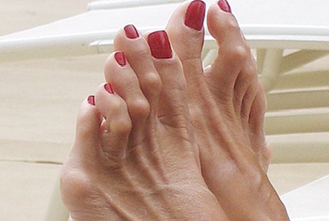 Hội chứng 'ngón chân búa' hình thành do đi dép xỏ ngón thường xuyên
