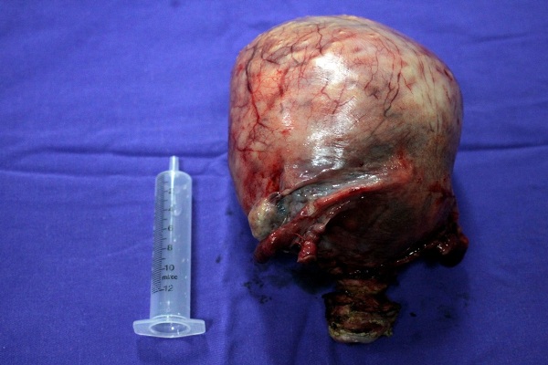 Khối u bị vôi hóa nặng gần 2kg được lấy ra khỏi bụng của bệnh nhân