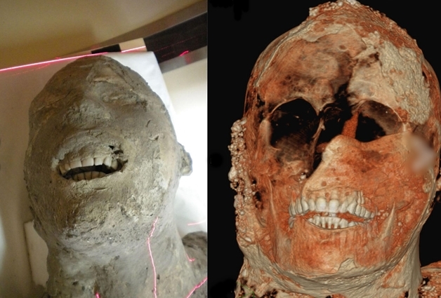 Ảnh chụp cắt lớp của 1 xác ướp thạch cao Pompeii