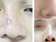 Cô gái 29 tuổi bị biến chứng sau nâng mũi làm đẹp 'chui' ở chung cư