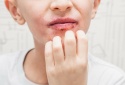 Trẻ nhỏ có thể bị dị ứng kem đánh răng gây bệnh nghiêm trọng