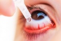 Lạm dụng corticoid nhỏ mắt có thể làm tăng nguy cơ mắc glaucoma gây mù vĩnh viễn