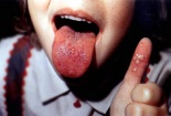 Bệnh tay chân miệng đã có vaccin đặc trị
