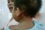 Uống thuốc xong trẻ sùi bọt mép, co giật, bỏng da toàn thân