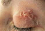Vướng bệnh vì lười vệ sinh cá nhân