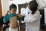 Triệu chứng và cách phòng ngừa bệnh thủy đậu