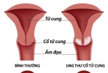 Cảnh giác 7 dấu hiệu ung thư cổ tử cung