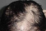 Trọc lốc đầu vì chăm sóc tóc không đúng cách