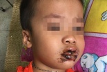 Ăn nhầm bột thông cống, 4 cháu bé nhập viện tập thể