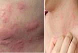 Mẩn ngứa lâu có thể là triệu chứng của ung thư da