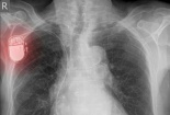 Thiết bị cấy ghép không dây tăng năng suất chất lượng y tế