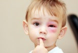 Các bước sơ cứu nhanh khi trẻ bị động vật, côn trùng cắn 