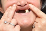 Ru rú trong nhà vì bác sỹ 'lỡ' làm rụng mất đôi răng cửa 
