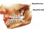 Tìm ra cách giúp người mọc răng không giới hạn