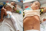 Nghịch kíp nổ vì tưởng là đồ chơi, bé 8 tuổi gãy xương lồi cầu