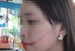 Nữ sinh lớp 9 bị bạn cùng học võ dùng dao nhọn rạch mặt