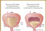 Đi tiểu nhiều, có phải bệnh lý?