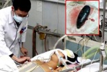 Suýt chết vì ăn canh mật cá trắm