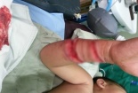 Rùng mình nghe kể chuyện bé 4 tuổi ở Cà Mau bị cá sấu cắn nát tay