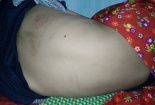 Bị mèo cào, bé trai tử vong vì lây bệnh dại