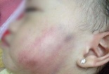 Bé gái 16 tháng tuổi bị bầm tím mặt: Đình chỉ hoạt động Ánh Sao, công an vào cuộc