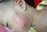 Gia đình tố bé gái 1 tuổi bị tát bầm mặt, cô giáo khăng khăng nói trẻ bị ngã