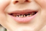 Vạch trần ' sát thủ' phá hủy hàm răng vĩnh viễn