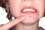 Những cách trị mụn 'sai bét' khiến ung thư da phát triển mạnh 