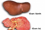 Cảnh báo tác hại của bia rượu 'hung thần' gây các bệnh về gan