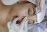 Mũi bị hoại tử, biến dạng vì nâng mũi thẩm mỹ bằng chỉ