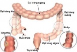 Ung thư đại trực tràng: Ngày càng nhiều người trẻ mắc bệnh