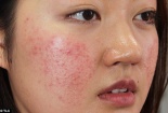 Cần hỏi kỹ tiền sử dị ứng thuốc của bệnh nhân trước khi kê đơn