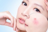 Những thói quen hàng ngày khiến da mụn trở nên tồi tệ hơn 