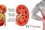Coi chừng sỏi thận từ những thói quen tưởng bình thường 