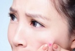 Vị trí mụn mọc trên mặt nói gì về tình trạng sức khỏe?