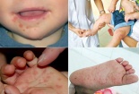Bộ Y tế cảnh báo bệnh tay chân miệng có khả năng thành dịch lớn