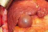 Ung thư gan vì một món ăn khoái khẩu của người Việt