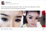 Loét giác mạc vì kính áp tròng