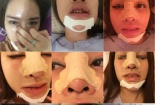 2 phụ nữ hoại tử vì tiêm filler: Hồi chuông cảnh báo đầy sức nặng