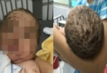 Tắm lá trị bệnh thủy đậu bé trai bị nhiễm độc nặng