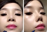 Nâng mũi siêu tốc bằng Serum: 'thần dược' hay trò quảng cáo lố?