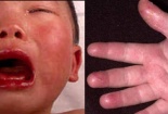 Bệnh mùa hè ở trẻ khiến cả thế giới khiếp sợ vì những biểu hiện quen thuộc mà nguy hiểm